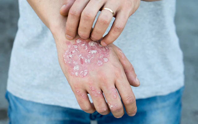 Skin Disorders